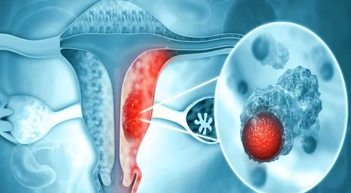 Is-abnormal-uterine-bleeding-a-sign-of-cancer