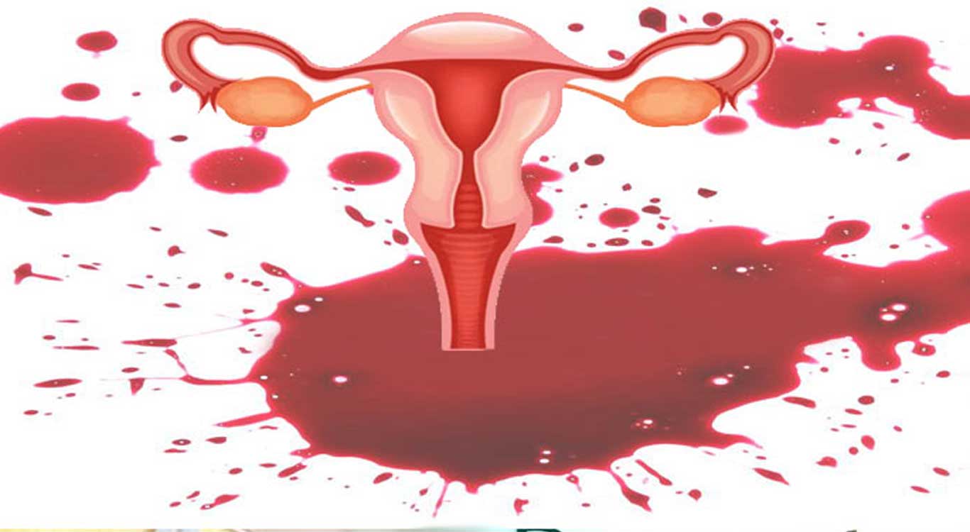Abnormal-uterine-bleeding-AUB