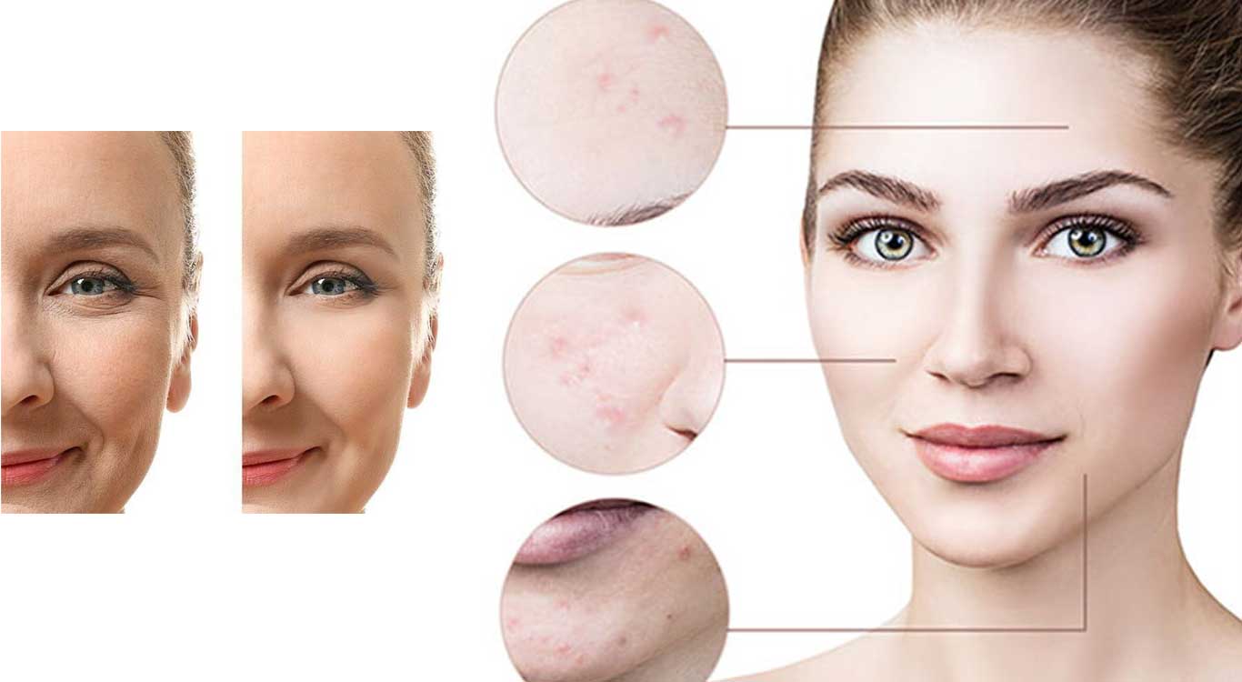 Benefits-of-Nanofat-Injection-for-Acne-Scars
