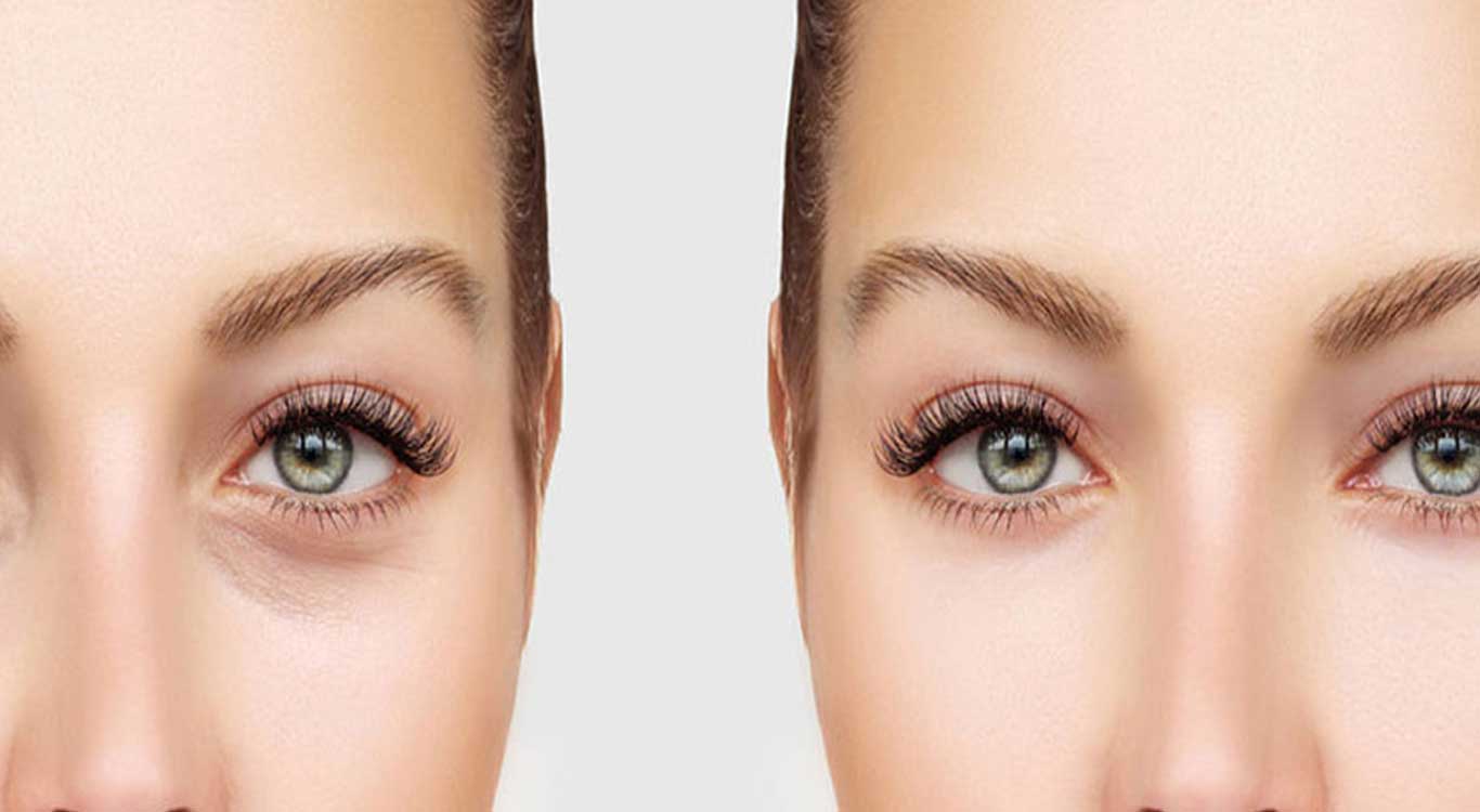 Blepharoplasty-for-eye-sockets