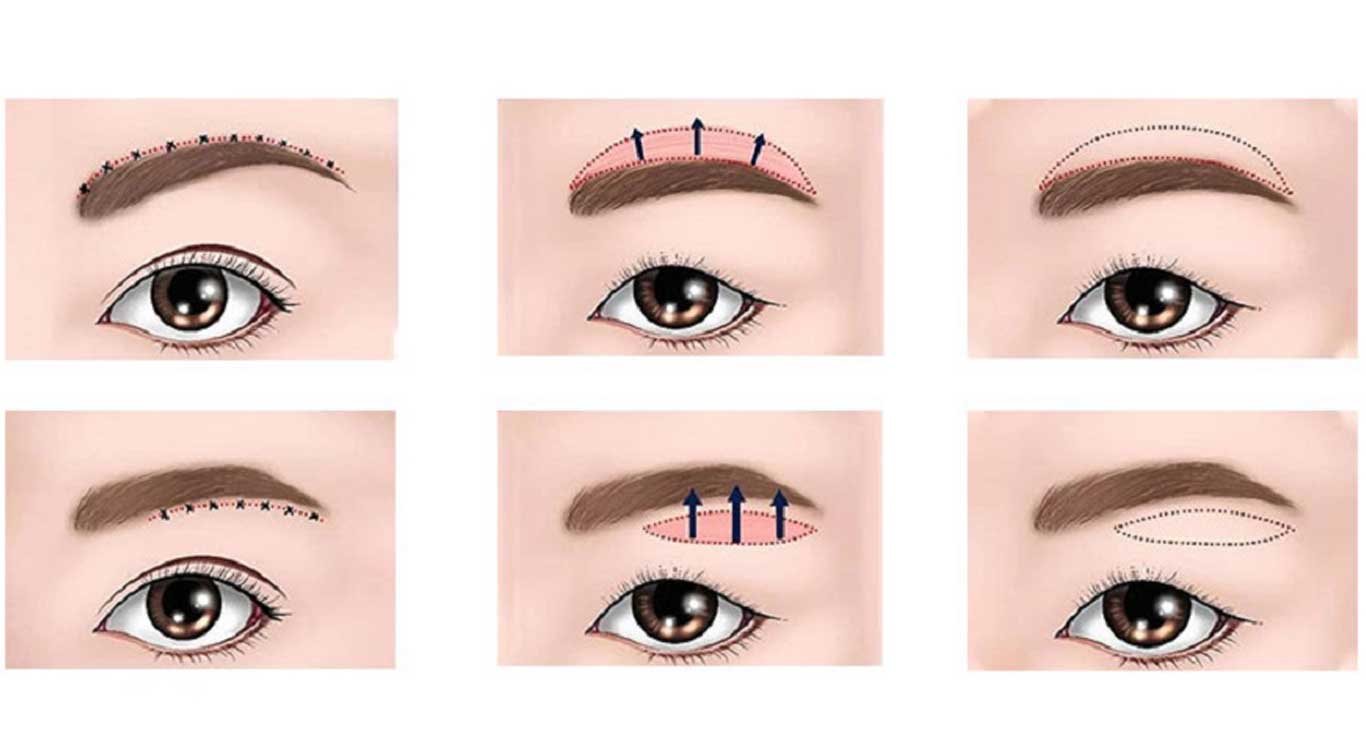 Direct-brow-lift-vs.-surgical-brow-lift