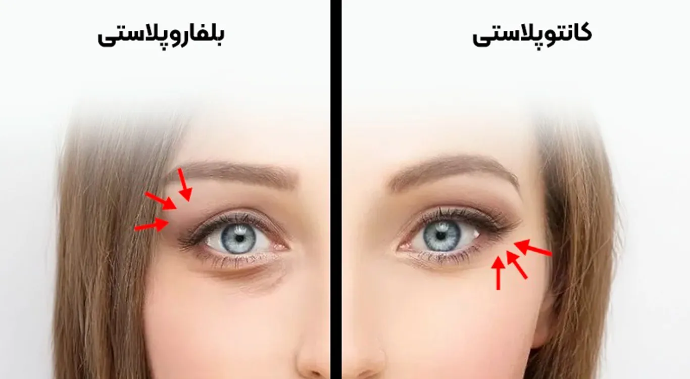 Epicanthoplasty-or-Blepharoplasty-What-Truly-Matters