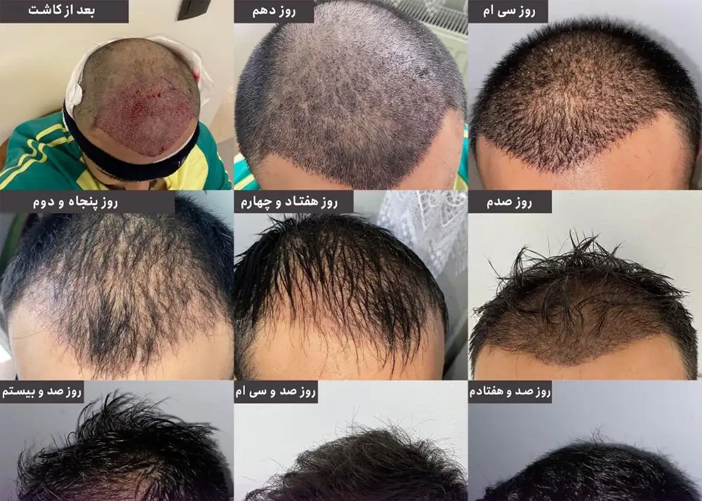 Hair-transplantation-using-the-proliferative-method