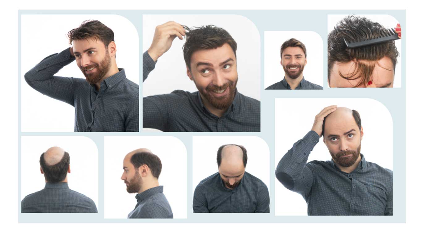 Modern-hair-transplantation-2025 Modern-hair-transplantation-2025