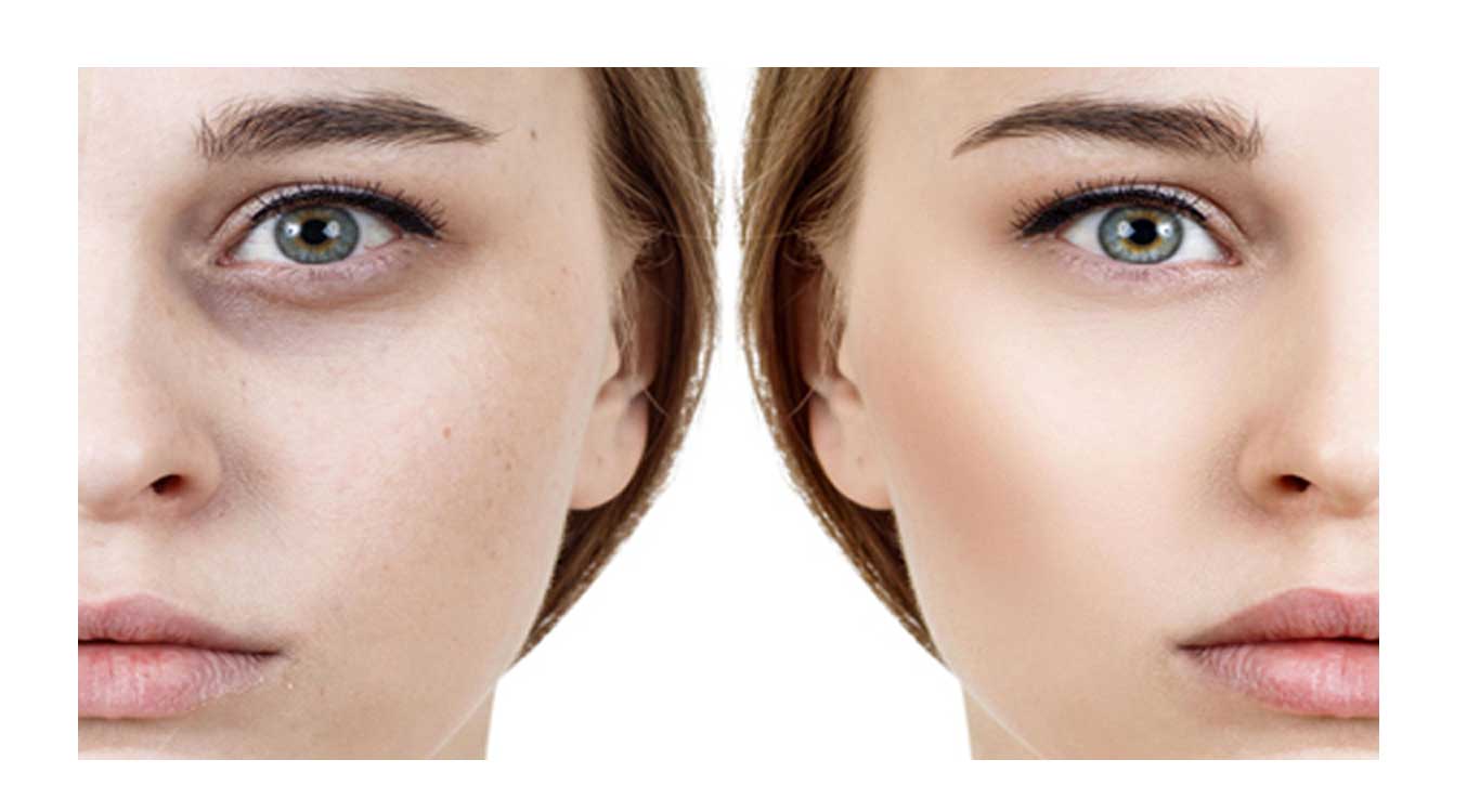 Removing-dark-circles-under-the-eyes-with-Bi-fitt