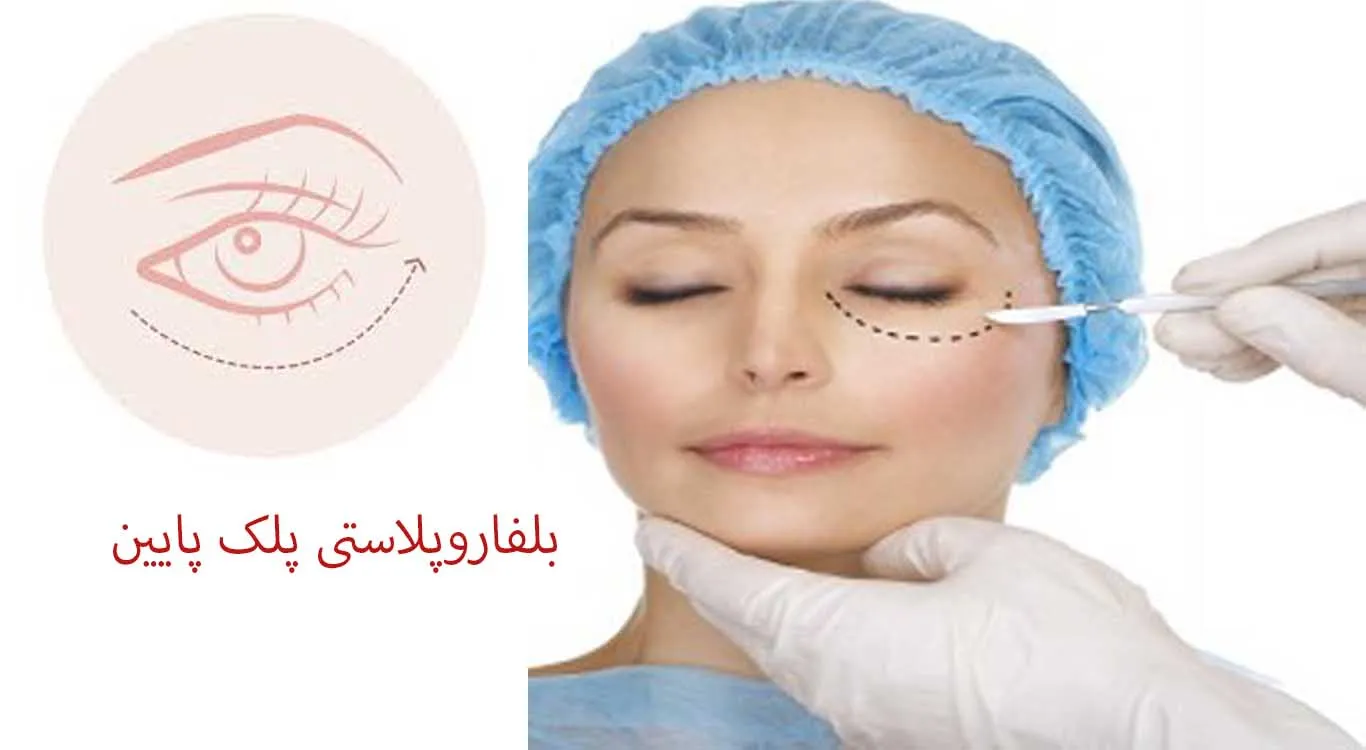 Surgery-puffiness-under-the-eyes-with-lower-eyelid-blepharoplasty