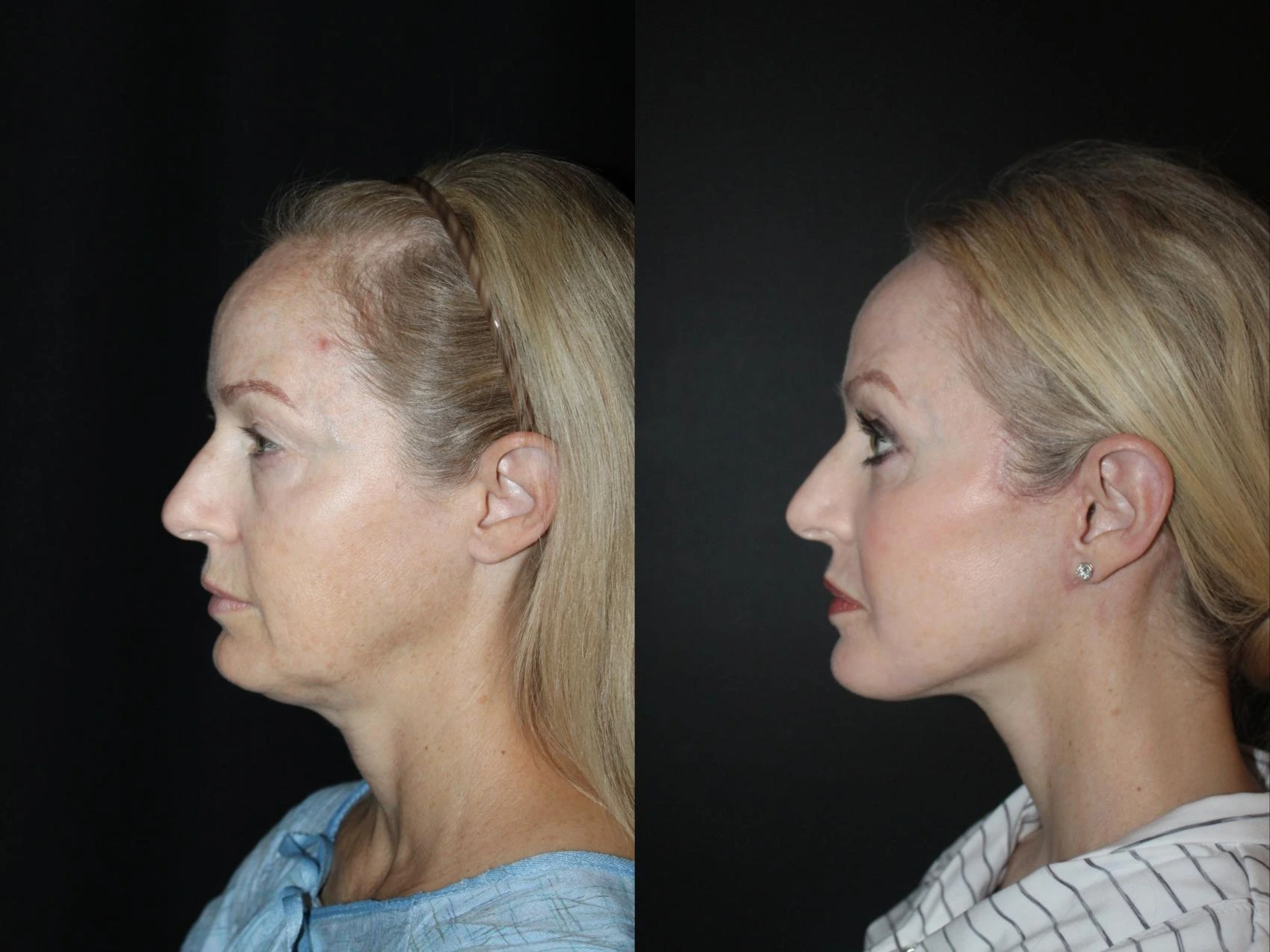 The-difference-between-Max-Lift-and-other-facelift-methods