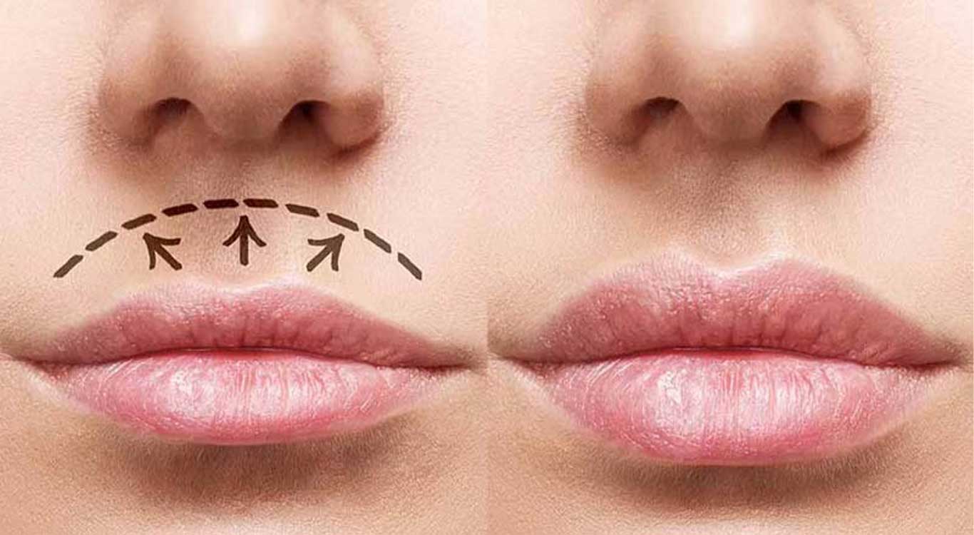 The-difference-between-lip-augmentation-and-lip-gel-and-filler-injections