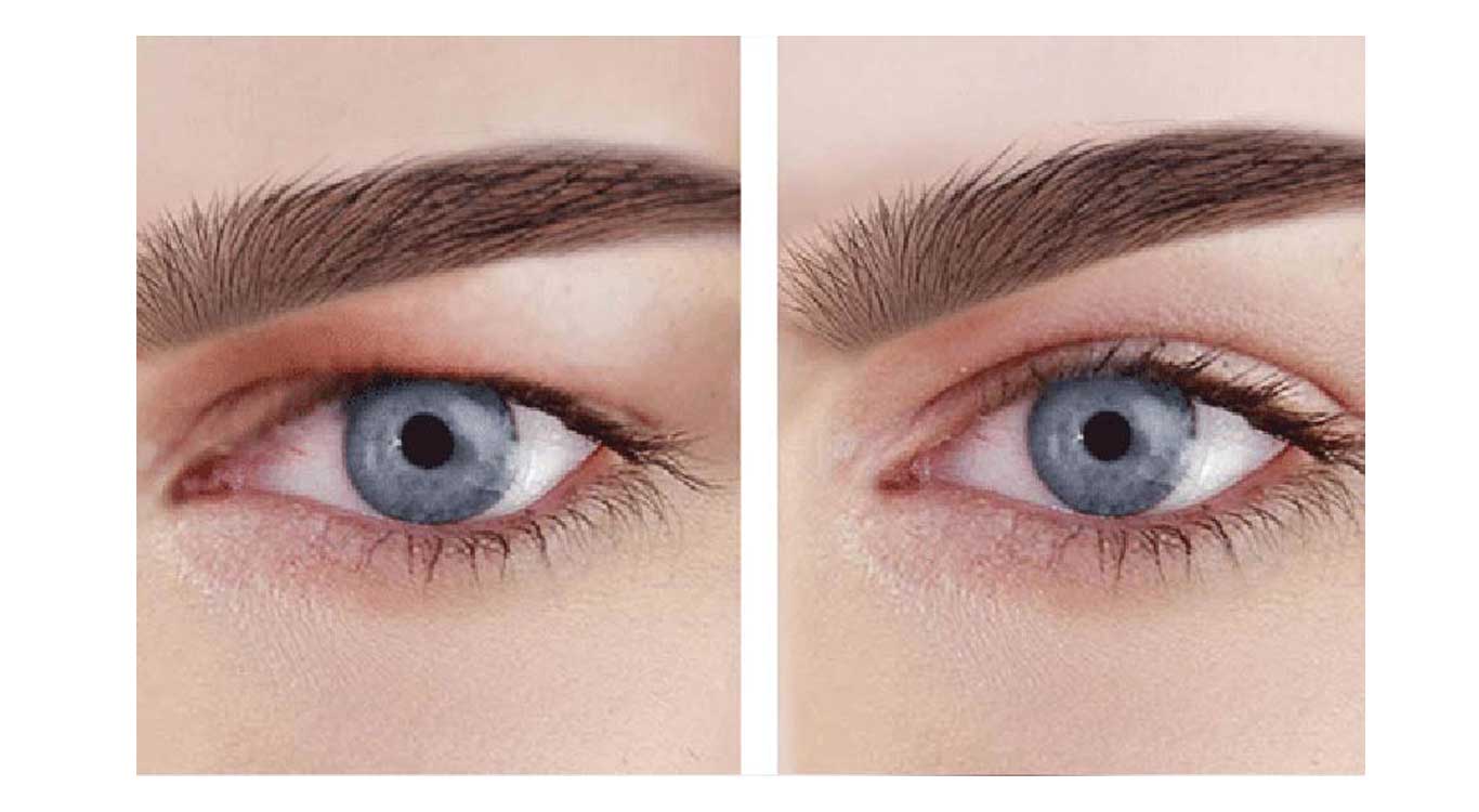 Training-on-various-blepharoplasty-surgery-models